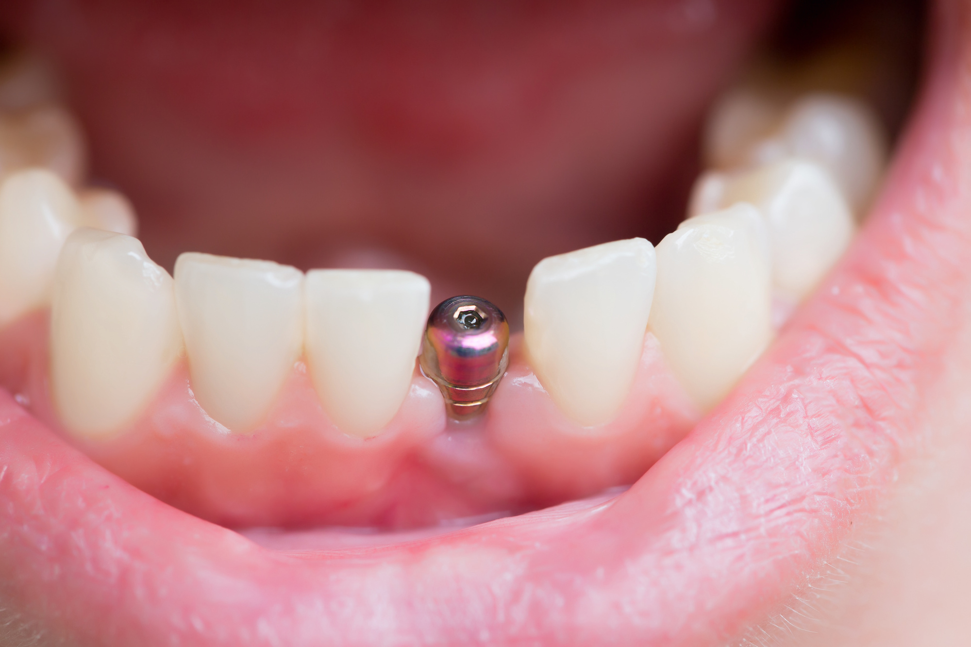 dental-implant-restoration.jpeg
