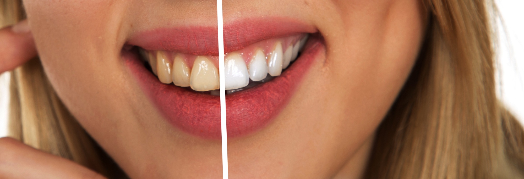How Long Does Teeth Whitening Last